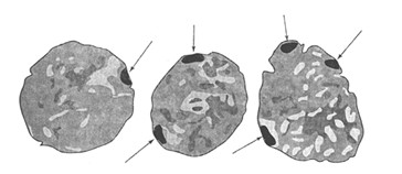  Рис. 7.5. Ядра клеток слизистой оболочки ротовой полости человека с различным числом телец Барра